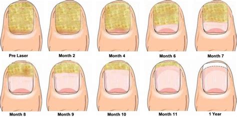 Laser Nail Fungus Treatment Weston Hcg Center