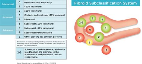 Fibroids - Anthony Siow