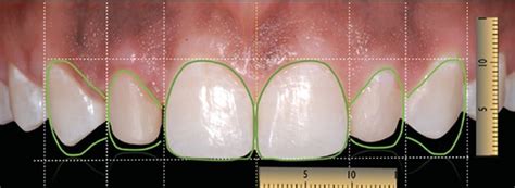 Management Of Peg Shaped Maxillary Lateral Incisors And Congenitally