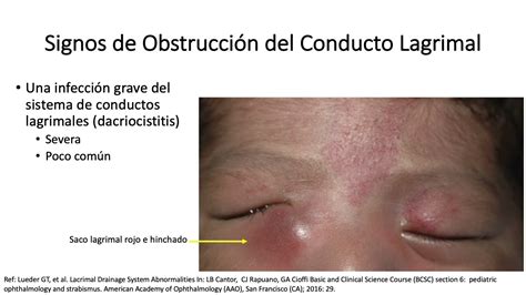 Nasolacrimal Cyst