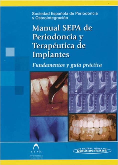 Manual Sepa De Periodoncia Y Terap Utica De Implantes El Manual Sepa De