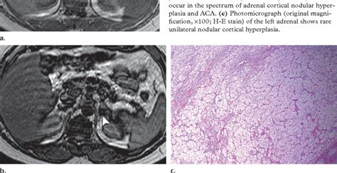 Figure 1 From From The Radiologic Pathology Archives 1 Adrenal Tumors