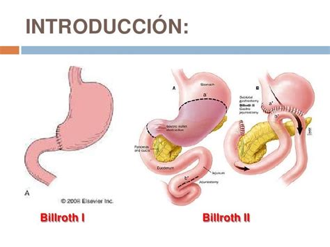 Difference Between Billroth I And Billroth Ii