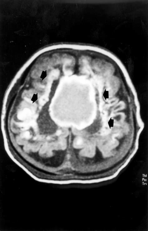 Complex Consanguinity Associated With Short Rib Polydactyly Syndrome