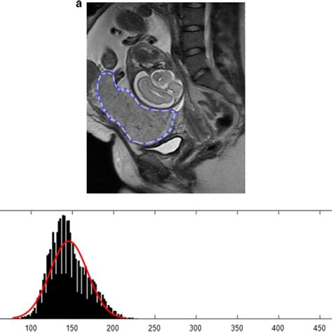 A 26 Year Old Woman With A Normal Placenta A Sagittal T2 Mr Image Download Scientific Diagram