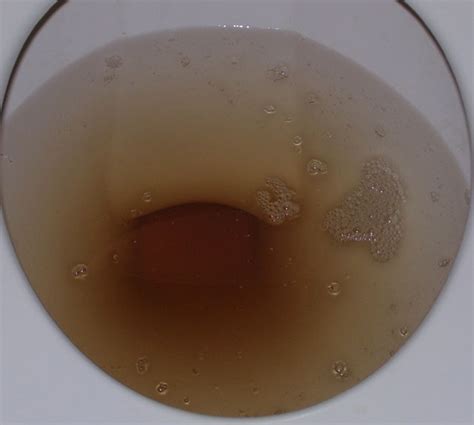 Murky Urine 7 Common Causes Of Cloudy Urine