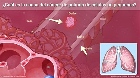 Comprender El Cáncer De Pulmón De Células No Pequeñas