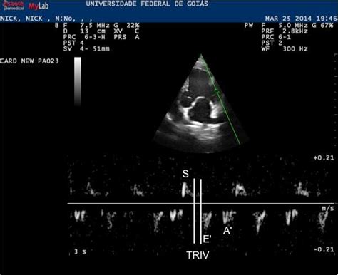 Doppler Tecidual Do Anel Mitral Identificando O Tempo De Relaxamento