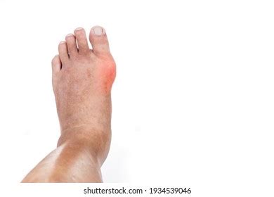 Man Swollen Deformed Inflammed Left Foot Stock Photo 1934538983