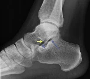 Subtalar Joint Arthritis: Causes, Symptoms, Diagnosis & Treatment