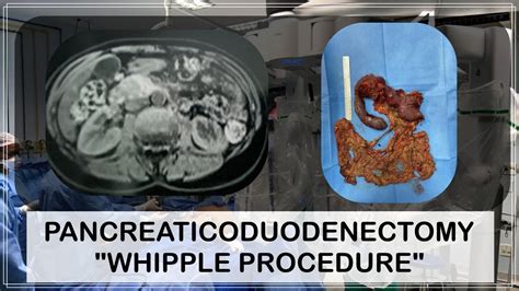 Pancreaticoduodenectomy Whipple Procedure Youtube