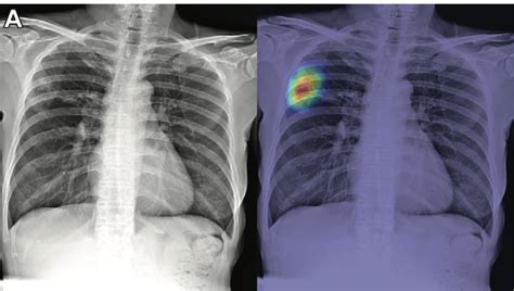 Tuberculosis Lung X Ray