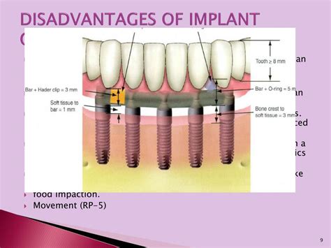 Ppt The Edentulous Mandible An Organized Approach To Implant