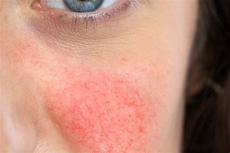 What Is Rosacea And How Can It Be Treated