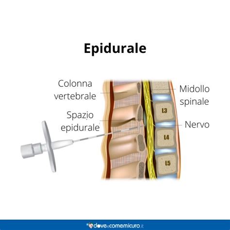 Epidurale cosè anestesia e effetti collaterali parto