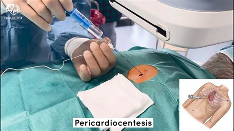 Pericardiocentesis - YouTube