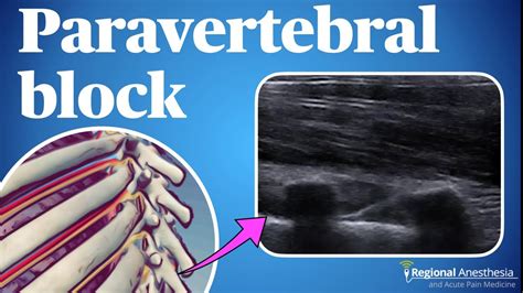 Ultrasound Guided Thoracic Paravertebral Block Youtube