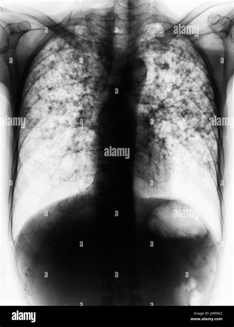 Pulmonary Tuberculosis Film Chest X Ray Show Fibrosis Interstitial Infiltration Both Lung