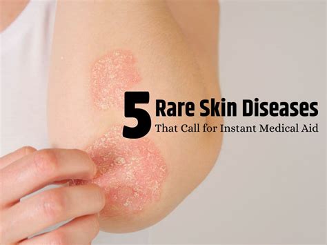 Don't Ignore These! 5 Rare Skin Diseases That Demand Urgent Medical ...