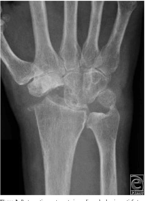 Figure 3 From Simultaneous Avascular Necrosis Of The Lunate And