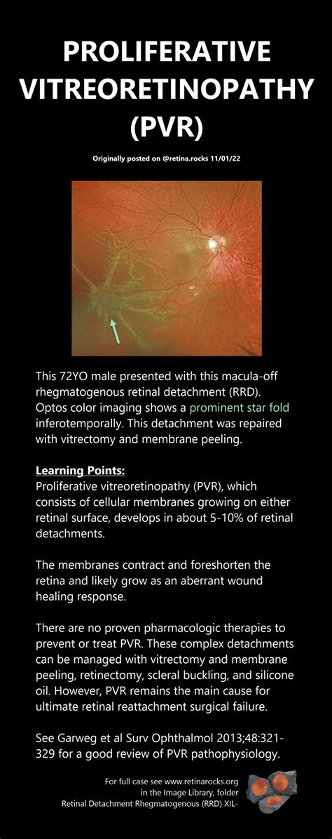 Vitreous Vitreoretinal Interface Abnormalities And Peripheral Retina