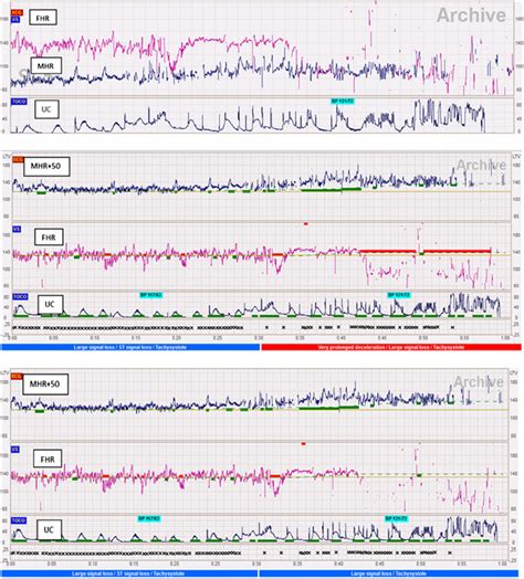 Maternal Heart Rate Mhr Baseline Misinterpreted As A Prolonged Fetal Download Scientific