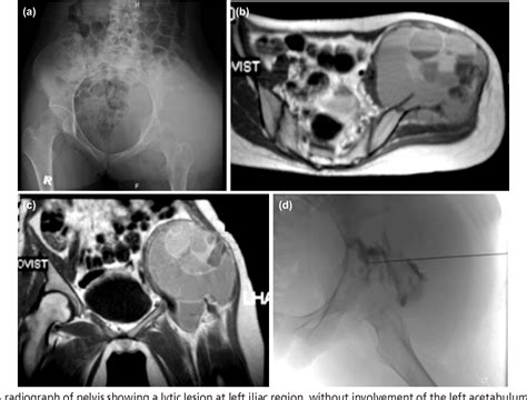 Figure 1 From Iliac Telangiectatic Osteosarcoma A Rare Presentation