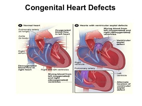 Congenital Heart Defects