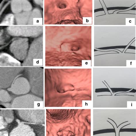 Reporting Template For Anomalous Aortic Origin Of The Coronary Arteries