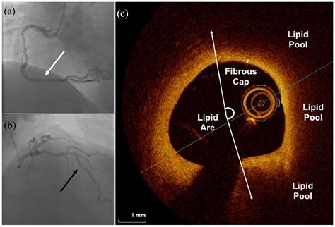 Management Of Multivessel Coronary Artery Disease In Patients With Non