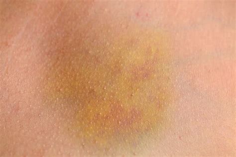 Yellow Age Spots On Skin 656820 What Causes Yellow Spots On Skin