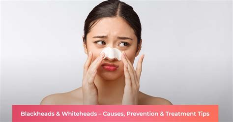 Blackheads and Whiteheads – Causes, Prevention & Treatment Tips