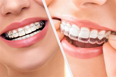 Clear Aligners Vs Traditional Braces Mint Dental