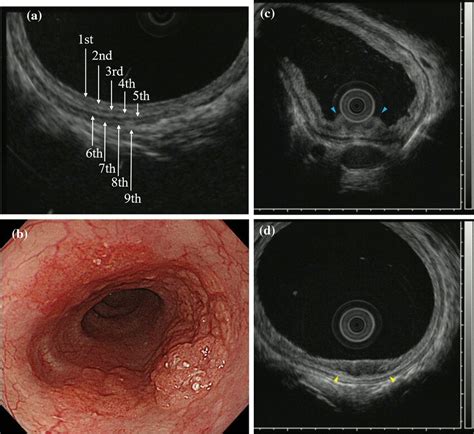 Typical Eus Image Showing The Layered Structure Of The Esophageal Wall Download Scientific