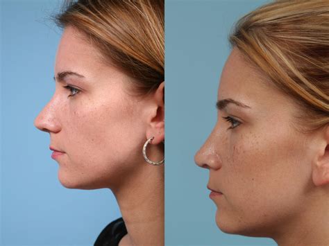 An Overview On The Pros Cons Of Rhinoplasty Surgery Fantasia