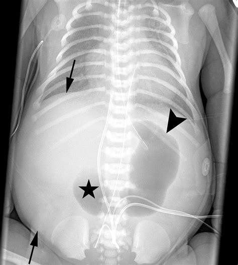 Fetal Hepatomegaly Causes And Associations Radiographics