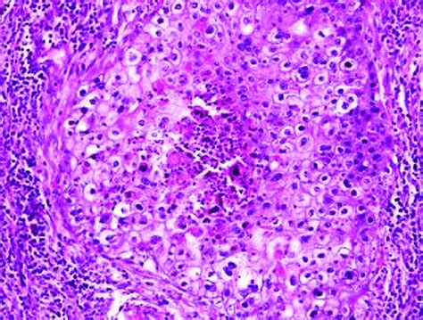 Clear Cell Carcinoma Tumor Nest With Well Defined Borders And Central