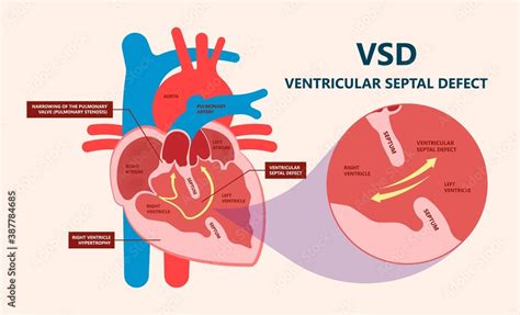 Cath Lab Atrial Septal Defect Tetralogy Of Fallot Patent Foramen Ovale