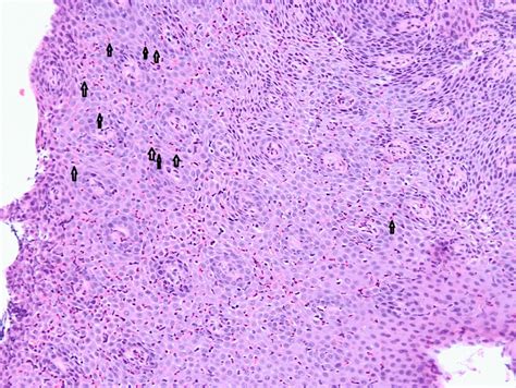 Classic Histological Findings Of Eosinophilic Esophagitis