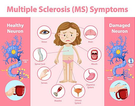 Multiple Sclerosis Ms Symptoms Information Infographic System Face ...