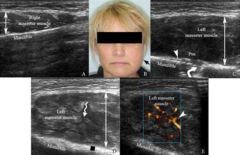 Ultrasonographic Assessment Of Masseter Muscle Region And Minimally Invasive Treatment Of Post