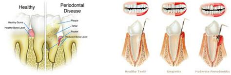 Etiology Of Periodontal Diseases Dental Hygiene