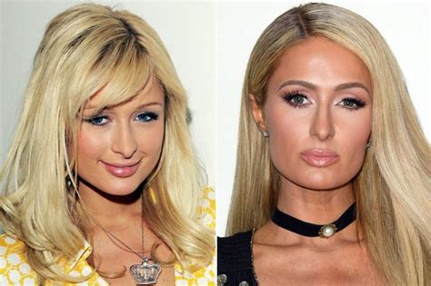 Paris Hilton Before And After Surgery Telegraph