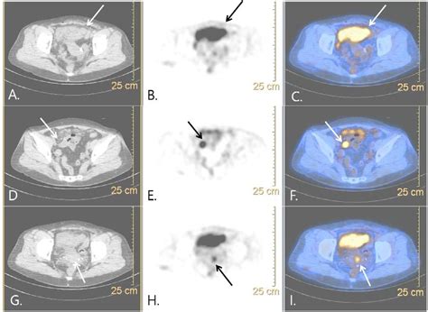 Figure 3 From Imaging Features Of Primary Peritoneal Serous Carcinoma