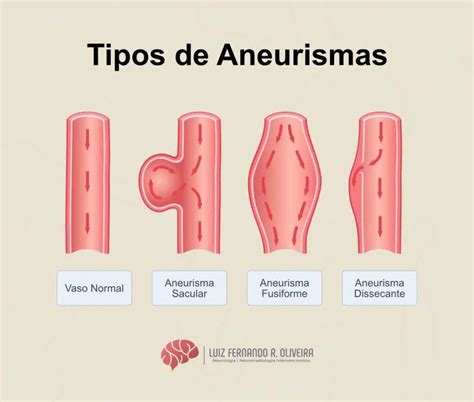 Aneurismas Cerebrais O Que Causa Sintomas E Tratamentos