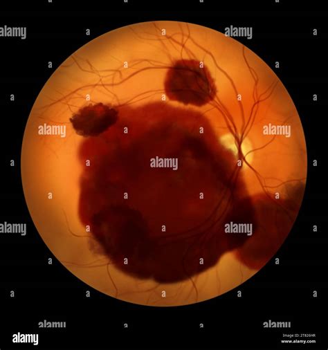 Illustration Of A Subretinal Haemorrhage Observed During Ophthalmoscopy