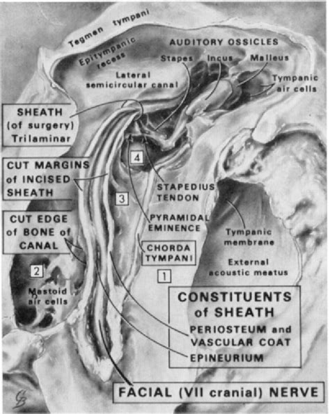 Figure 3 from Surgical Anatomy of the Chorda Tympani | Semantic Scholar