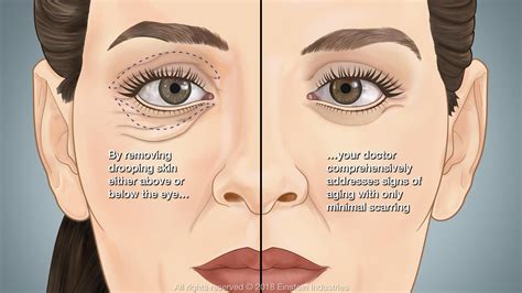 Droopy Lower Eyelid