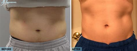 Trusculpt D Body Contouring In Hagerstown