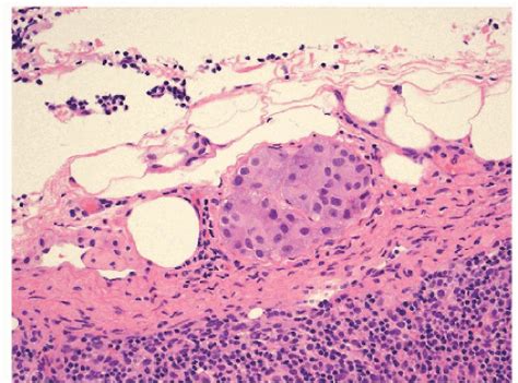 Sentinel Lymph Nodes | Basicmedical Key